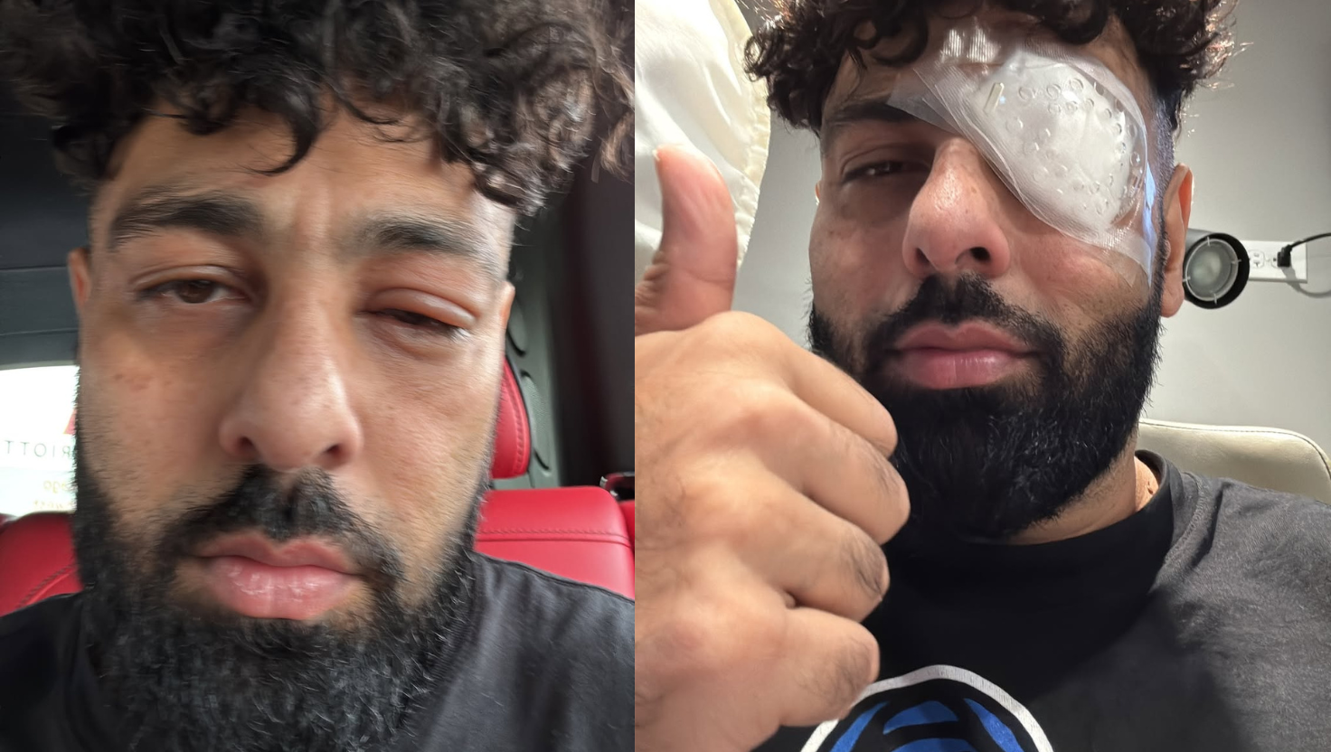 “बादशाह की आँख में लगी कॉर्नियल घर्षण चोट का इलाज | "Image Courtesy:instagram/@badboyshah